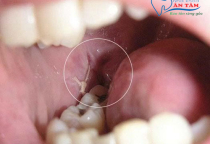 NHA KHOA BẢO TỒN - VÌ SAO XUẤT HIỆN MÀNG TRẮNG SAU KHI NHỔ RĂNG? NHA KHOA BẢO TỒN - VÌ SAO XUẤT HIỆN MÀNG TRẮNG SAU KHI NHỔ RĂNG?
