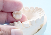 NHA KHOA BẢO TỒN - CÁC LOẠI RĂNG SỨ PHỔ BIẾN NHẤT TRÊN THỊ TRƯỜNG HIỆN NAY  NHA KHOA BẢO TỒN - CÁC LOẠI RĂNG SỨ PHỔ BIẾN NHẤT TRÊN THỊ TRƯỜNG HIỆN NAY