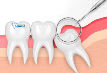 NHA KHOA BẢO TỒN - VIÊM LỢI TRÙM RĂNG KHÔN NHA KHOA BẢO TỒN - VIÊM LỢI TRÙM RĂNG KHÔN