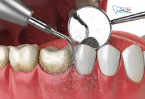 NHA KHOA BẢO TỒN - CẠO VÔI RĂNG BẰNG SÓNG SIÊU ÂM NHA KHOA BẢO TỒN - CẠO VÔI RĂNG BẰNG SÓNG SIÊU ÂM