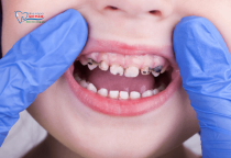 NHA KHOA BẢO TỒN - XIẾT ĂN RĂNG Ở TRẺ EM NHA KHOA BẢO TỒN - XIẾT ĂN RĂNG Ở TRẺ EM
