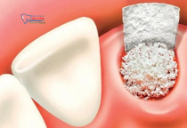 NHA KHOA BẢO TỒN - VIÊM Ổ RĂNG KHÔ LÀ GÌ? NHA KHOA BẢO TỒN - VIÊM Ổ RĂNG KHÔ LÀ GÌ?