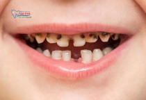 NHA KHOA BẢO TỒN - SÂU RĂNG SỮA Ở TRẺ EM NHA KHOA BẢO TỒN - SÂU RĂNG SỮA Ở TRẺ EM