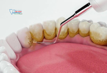 NHA KHOA BẢO TỒN - VÌ SAO CẦN LẤY VÔI RĂNG ĐỊNH KỲ? NHA KHOA BẢO TỒN - VÌ SAO CẦN LẤY VÔI RĂNG ĐỊNH KỲ?