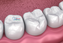 NHA KHOA BẢO TỒN - TRÁM RĂNG COMPOSITE CÓ TỐT KHÔNG? NHA KHOA BẢO TỒN - TRÁM RĂNG COMPOSITE CÓ TỐT KHÔNG?
