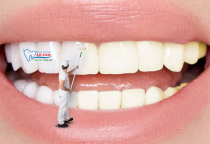 NHA KHOA BẢO TỒN - TẨY TRẮNG RĂNG GIỮ ĐƯỢC BAO LÂU? NHA KHOA BẢO TỒN - TẨY TRẮNG RĂNG GIỮ ĐƯỢC BAO LÂU?