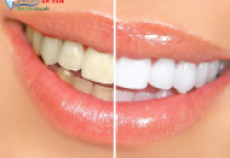 NHA KHOA BẢO TỒN TẨY TRẮNG RĂNG AN TOÀN: NHỮNG ĐIỀU BẠN CẦN BIẾT NHA KHOA BẢO TỒN TẨY TRẮNG RĂNG AN TOÀN: NHỮNG ĐIỀU BẠN CẦN BIẾT