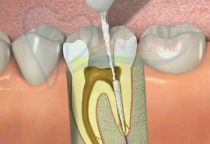 ĐIỀU TRỊ TỦY RĂNG TẠI NHA KHOA ÂN TÂM  ĐIỀU TRỊ TỦY RĂNG TẠI NHA KHOA ÂN TÂM