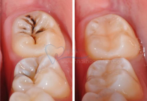 QUY TRÌNH HÀN RĂNG SÂU “CHUẨN” DIỄN RA NHƯ THẾ NÀO? QUY TRÌNH HÀN RĂNG SÂU “CHUẨN” DIỄN RA NHƯ THẾ NÀO?