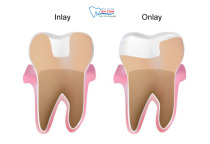 NHA KHOA BẢO TỒN - NHỮNG ĐIỀU CẦN BIẾT VỀ TRÁM INLAY/ONLAY NHA KHOA BẢO TỒN - NHỮNG ĐIỀU CẦN BIẾT VỀ TRÁM INLAY/ONLAY