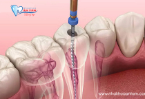 CÓ NÊN BỌC SỨ CHO RĂNG ĐÃ LẤY TỦY KHÔNG? CÓ NÊN BỌC SỨ CHO RĂNG ĐÃ LẤY TỦY KHÔNG?