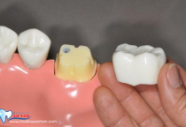 RĂNG ĐÃ LẤY TỦY CÓ CẦN BỌC SỨ KHÔNG? RĂNG ĐÃ LẤY TỦY CÓ CẦN BỌC SỨ KHÔNG?
