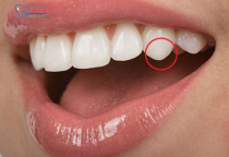 RĂNG NANH LÀ GÌ? NHỮNG ĐIỀU CẦN BIẾT VỀ RĂNG NANH RĂNG NANH LÀ GÌ? NHỮNG ĐIỀU CẦN BIẾT VỀ RĂNG NANH