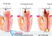 QUY TRÌNH LẤY TỦY RĂNG QUY TRÌNH LẤY TỦY RĂNG