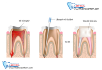NGUYÊN NHÂN VÀ CÁCH ĐIỀU TRỊ VIÊM TỦY RĂNG NGUYÊN NHÂN VÀ CÁCH ĐIỀU TRỊ VIÊM TỦY RĂNG