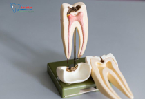 NHA KHOA BẢO TỒN - ĐIỀU TRỊ TỦY RĂNG BẢO TỒN RĂNG THẬT HIỆU QUẢ NHA KHOA BẢO TỒN - ĐIỀU TRỊ TỦY RĂNG BẢO TỒN RĂNG THẬT HIỆU QUẢ