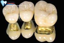 ƯU ĐIỂM CỦA RĂNG SỨ QUÝ KIM ƯU ĐIỂM CỦA RĂNG SỨ QUÝ KIM