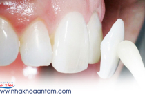 RĂNG KHÔNG ĐỀU CÓ DÁN SỨ VENEER ĐƯỢC KHÔNG? RĂNG KHÔNG ĐỀU CÓ DÁN SỨ VENEER ĐƯỢC KHÔNG?