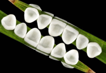 MẶT DÁN SỨ VENEER