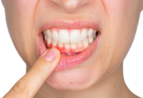NHA KHOA BẢO TỒN - DẤU HIỆU NHẬN BIẾT VIÊM NƯỚU RĂNG NHA KHOA BẢO TỒN - DẤU HIỆU NHẬN BIẾT VIÊM NƯỚU RĂNG