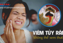 DẤU HIỆU NHẬN BIẾT BỆNH VIÊM TỦY RĂNG. DẤU HIỆU NHẬN BIẾT BỆNH VIÊM TỦY RĂNG.