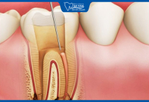 NHA KHOA BẢO TỒN - VIÊM TỦY RĂNG CÓ TỰ KHỎI KHÔNG? NHA KHOA BẢO TỒN - VIÊM TỦY RĂNG CÓ TỰ KHỎI KHÔNG?