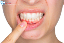BỆNH VIÊM NHA CHU LÀ GÌ? NGUYÊN NHÂN DO ĐÂU? BỆNH VIÊM NHA CHU LÀ GÌ? NGUYÊN NHÂN DO ĐÂU?