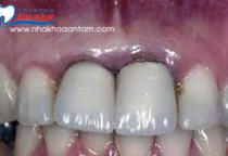 NÊN BỌC RĂNG SỨ KIM LOẠI HAY KHÔNG? VÀ CHƯƠNG TRÌNH CÓ 102 CỦA NHA KHOA ÂN TÂM NÊN BỌC RĂNG SỨ KIM LOẠI HAY KHÔNG? VÀ CHƯƠNG TRÌNH CÓ 102 CỦA NHA KHOA ÂN TÂM