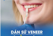 MẶT DÁN SỨ VENEER CÓ BỀN KHÔNG? MẶT DÁN SỨ VENEER CÓ BỀN KHÔNG?