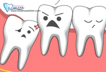 TRƯỜNG HỢP NÀO NÊN NHỔ RĂNG KHÔN VÀ TRƯỜNG HỢP NÀO THÌ KHÔNG NÊN?  TRƯỜNG HỢP NÀO NÊN NHỔ RĂNG KHÔN VÀ TRƯỜNG HỢP NÀO THÌ KHÔNG NÊN?