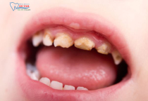 CÁCH ĐIỀU TRỊ XIẾT ĂN RĂNG Ở TRẺ EM AN TOÀN CÁCH ĐIỀU TRỊ XIẾT ĂN RĂNG Ở TRẺ EM AN TOÀN
