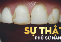 NHA KHOA BẢO TỒN - HẬU QUẢ KHI THỰC HIỆN PHỦ RĂNG SỨ NANO KHÔNG ĐÚNG CÁCH NHA KHOA BẢO TỒN - HẬU QUẢ KHI THỰC HIỆN PHỦ RĂNG SỨ NANO KHÔNG ĐÚNG CÁCH