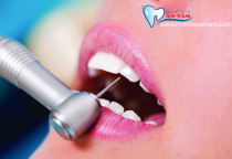 BỌC RĂNG SỨ KHÔNG CẦN MÀI RĂNG CÓ ĐƯỢC KHÔNG? BỌC RĂNG SỨ KHÔNG CẦN MÀI RĂNG CÓ ĐƯỢC KHÔNG?