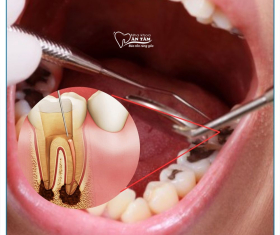 NHA KHOA BẢO TỒN - LẤY CHỈ MÁU RĂNG CÓ ĐAU KHÔNG?