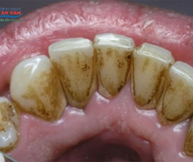 NHA KHOA BẢO TỒN - RĂNG ĐEN Ở MẶT TRONG DO ĐÂU?