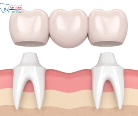 NHA KHOA BẢO TỒN - NHƯỢC ĐIỂM CỦA CẦU RĂNG SỨ LÀ GÌ?