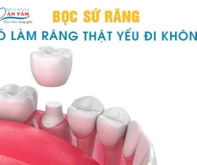 NHA KHOA BẢO TỒN - BỌC RĂNG SỨ CÓ LÀM RĂNG THẬT YẾU ĐI KHÔNG?
