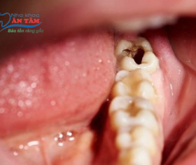 NHA KHOA BẢO TỒN - RĂNG SỐ 8 BỊ SÂU VỠ CÓ NGUY HIỂM KHÔNG?