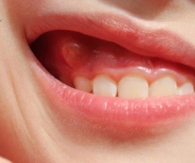 NHA KHOA BẢO TỒN - CÁCH NHẬN BIẾT VIÊM NHA CHU Ở TRẺ EM