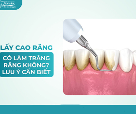 NHA KHOA BẢO TỒN - LẤY CAO RĂNG CÓ LÀM TRẮNG RĂNG KHÔNG?