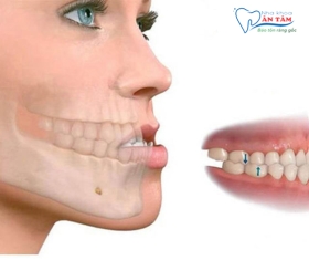 NHA KHOA BẢO TỒN - CÁCH NHẬN BIẾT SAI KHỚP CẮN LÀ GÌ?