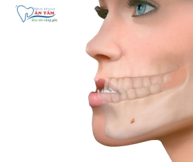 NHA KHOA BẢO TỒN - SAI KHỚP CẮN LOẠI 3 LÀ GÌ? CÁCH ĐIỀU TRỊ NHƯ THẾ NÀO?