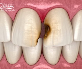 NHA KHOA BẢO TỒN - SÂU RĂNG CỬA NÊN LÀM GÌ?