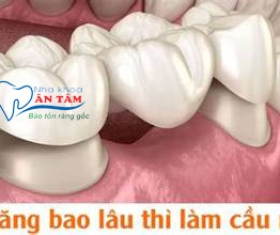 NHA KHOA BẢO TỒN - NHỔ RĂNG BAO LÂU THÌ LÀM CẦU RĂNG SỨ?