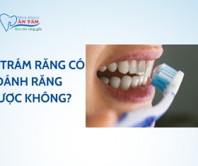 NHA KHOA BẢO TỒN - SAU KHI TRÁM RĂNG XONG CÓ ĐÁNH RĂNG ĐƯỢC KHÔNG?