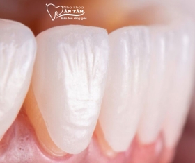 NHA KHOA BẢO TỒN - DÁN SỨ VENEER KHÔNG MÀI RĂNG LÀ GÌ?