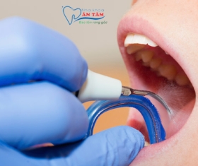 NHA KHOA BẢO TỒN - CẠO VÔI RĂNG CÓ BỊ Ê BUỐT KHÔNG?
