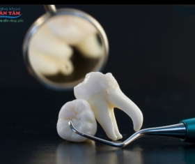 NHA KHOA BẢO TỒN - NHỔ RĂNG KHÔN BAO LÂU THÌ LÀNH?