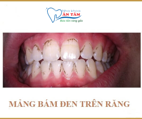 NHA KHOA BẢO TỒN - CÁCH LÀM SẠCH MẢNG BÁM ĐEN TRÊN RĂNG HIỆU QUẢ