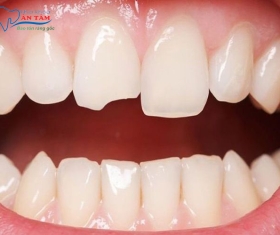 NHA KHOA BẢO TỒN - RĂNG BỊ GÃY CÓ TRÁM ĐƯỢC KHÔNG?